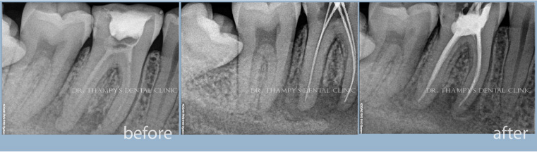 Re-treated root canal with laser sterilization