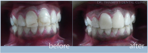 composite veneer for discolored and stained teeth
