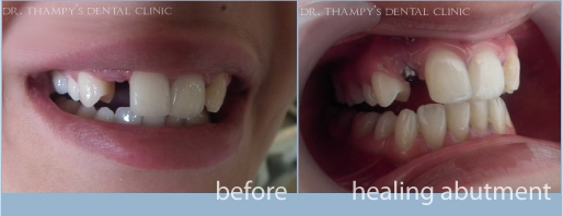 missing tooth and healing abutment  before implant