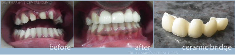 Dental Braces and Ceramic Bridge for Congenitally Missing Laterals