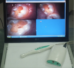 Intra oral digital camera in dental treatments