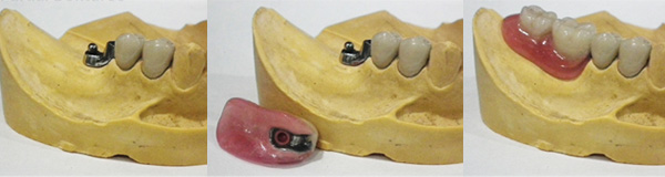 Precision Dentures