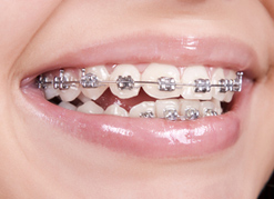 Dental Brace in Wollongong - Figtree Family Dental
